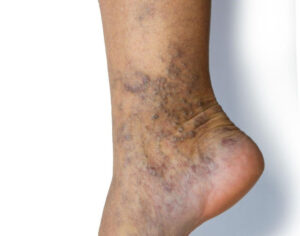 varicose veins in men treatment tips