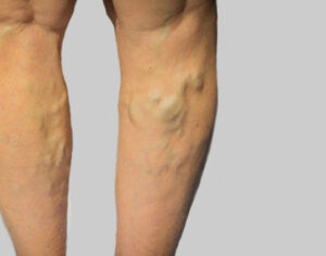 reason veins appear blue or green under skin