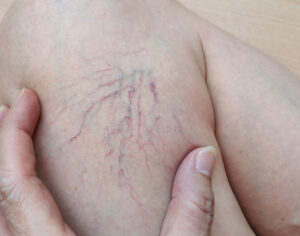 varicose veins in young adults causes