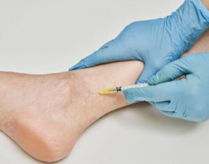 what are varicose veins explained simply