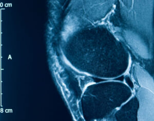 knee MRI before genicular artery embolization