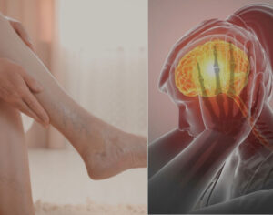 Chronic Stress Effects on Veins