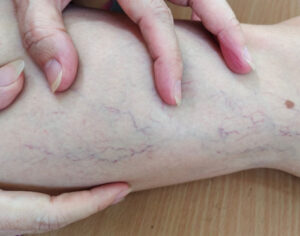 Genetic Risk Factors for Varicose Veins