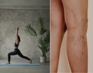 Varicose Vein Exercises