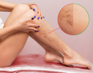DVT Symptoms and Causes