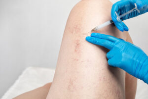 multiple treatments for your vein condition in Houston, TX