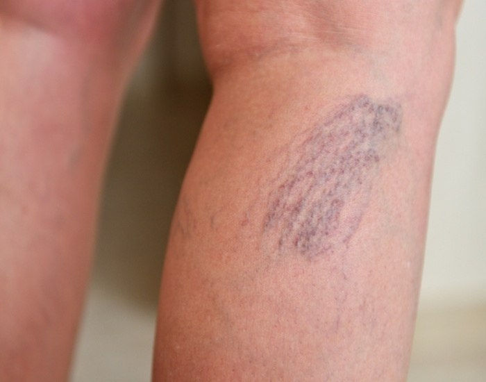 Varicose veins on female legs Varicose veins on female legs in Houston, TX