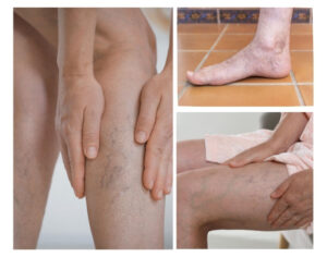 DVT symptoms
