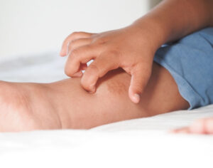 Can Itching Be a Symptom of Varicose Veins? Causes, Signs & Relief