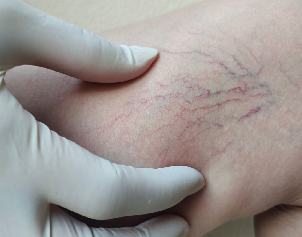 How to Treat Varicose Veins Without Surgery – Expert Tips from Houston Vein Specialists
