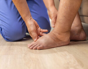 swollen calves & ankles after standing