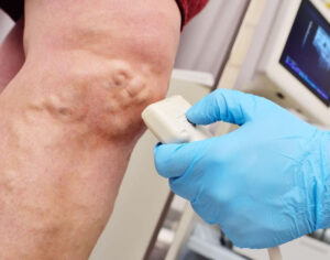 causes of leg skin discoloration and veins