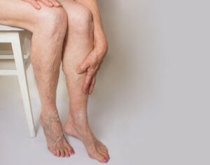 hard vein under skin in leg symptoms