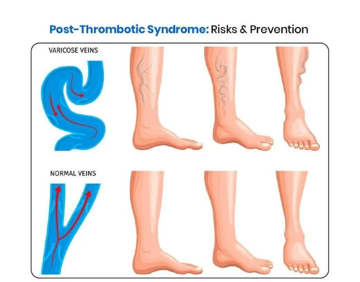 Post-Thrombotic Syndrome: Causes, Symptoms, and Treatment for Leg Problems After DVT
