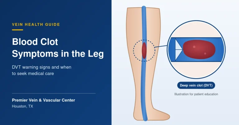 Medical illustration showing a deep vein blood clot in the leg