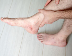 when to see a doctor for burning legs