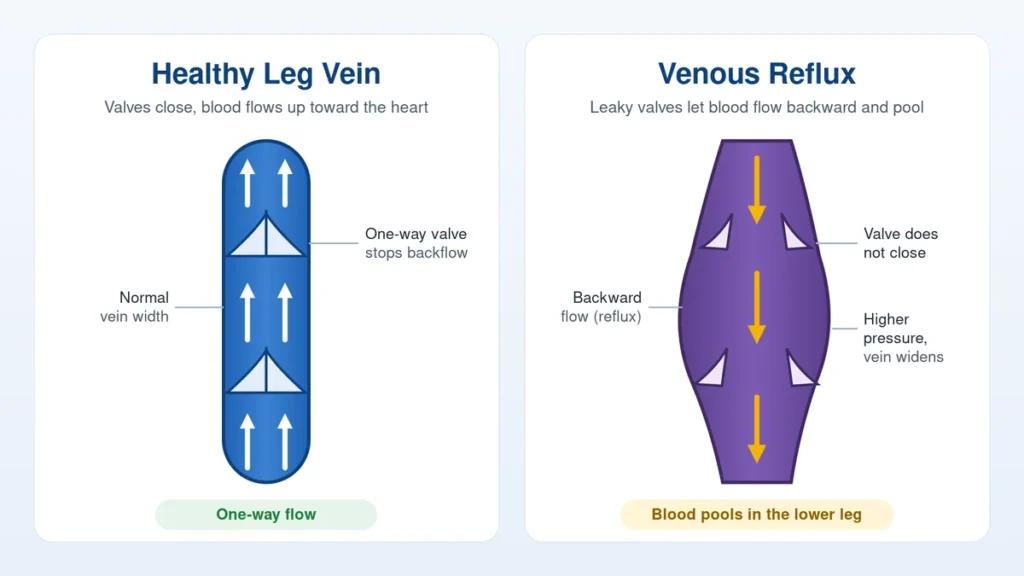 Illustration comparing healthy leg vein valves with venous reflux