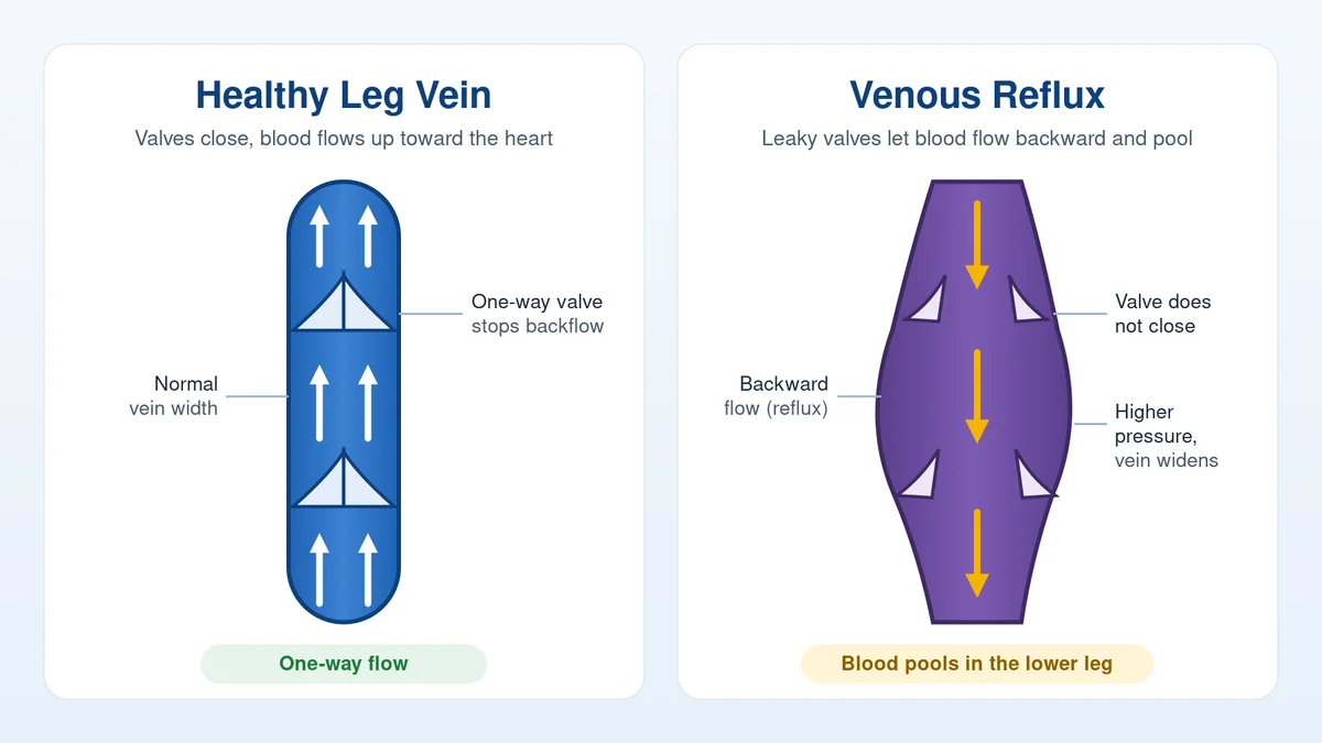 Illustration comparing healthy leg vein valves with venous reflux