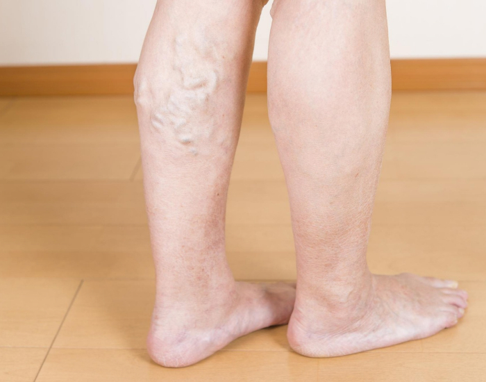 causes of bulging leg veins